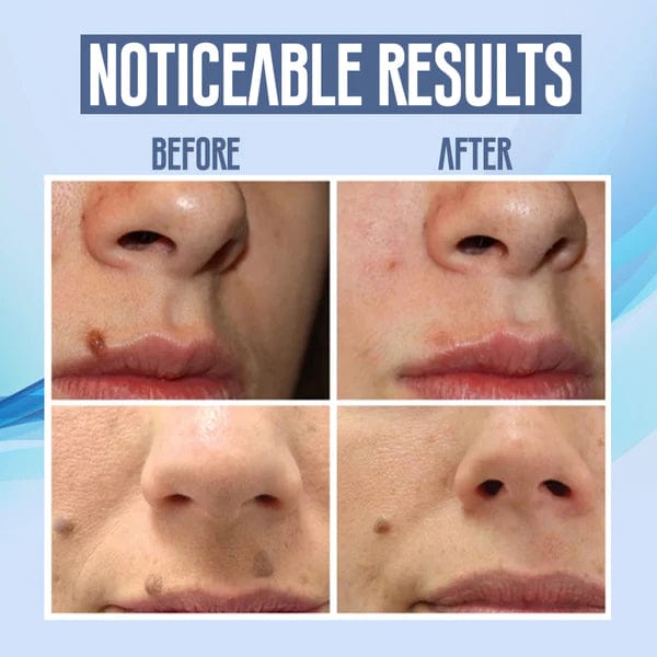 LumiClear™ Skin Pen — Reveal Smooth, Spotless Skin and Boost Your Confidence Instantly