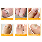 VeraNail™ — Clear, Confident Nails That Let You Bare Your Feet Proudly