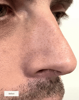 Hydro-Absorb™ Nose Patch — Wake Up to Smooth, Shine-Free Skin You Crave (8 Patches/box)