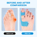 GlideAlign™ — Finally Walk Pain-Free with Invisible, All-Day Bunion Relief