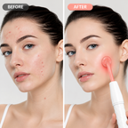 Blemora™ — Zap Acne Fast and Reveal Your Radiant, Youthful Glow Everyday