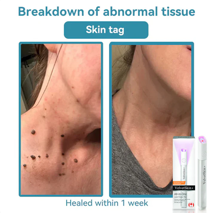 LumaClear™ — Precision Laser Power to Unleash Your Most Radiant, Confident Skin