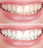 LuminaBright™ — Light Up Your Smile Instantly with Gentle, Healthy Whitening