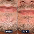 GlowSilk™ — Watch Scars Disappear and Reveal Radiant, Youthful Skin Instantly