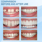 LumaSeal™ — Instantly Restore Your Smile with Invisible, Featherlight Comfort