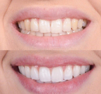 LumiSheen™ — Instantly Ignite Confidence with a Brilliant, Pain-Free Smile