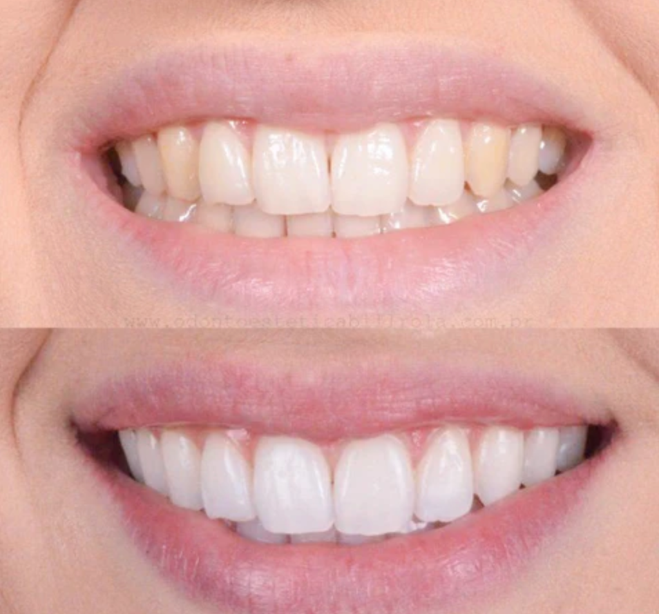 LumiSheen™ — Instantly Ignite Confidence with a Brilliant, Pain-Free Smile