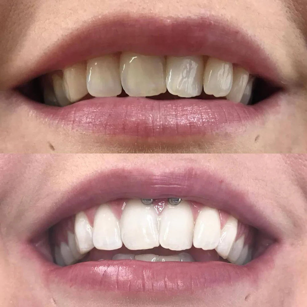 RadianceSwipe™ Whitening Pen — Unleash a Dazzling Smile That Commands Attention Instantly