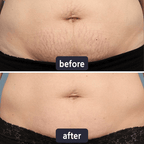 GlowSilk™ — Watch Scars Disappear and Reveal Radiant, Youthful Skin Instantly