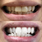 RadianceSwipe™ Whitening Pen — Unleash a Dazzling Smile That Commands Attention Instantly