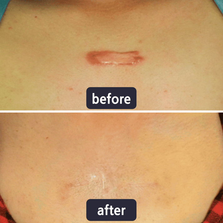 GlowSilk™ — Watch Scars Disappear and Reveal Radiant, Youthful Skin Instantly