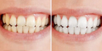 LumiSheen™ — Instantly Ignite Confidence with a Brilliant, Pain-Free Smile