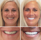 FlexiSmile™ — Mold Your Perfect Smile and Own Every Moment