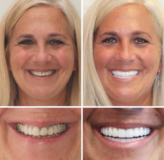 FlexiSmile™ — Mold Your Perfect Smile and Own Every Moment