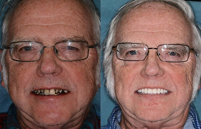 FlexiSmile™ — Mold Your Perfect Smile and Own Every Moment
